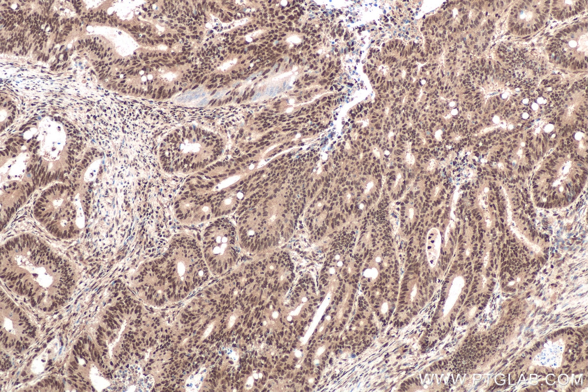 Immunohistochemical analysis of paraffin-embedded human colon cancer tissue slide using KHC0679 (UBA1 IHC Kit).