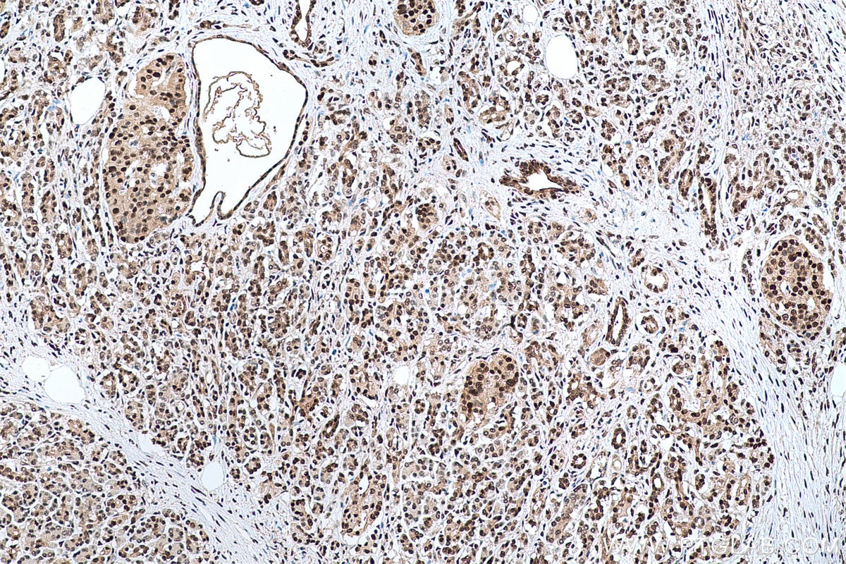 Immunohistochemical analysis of paraffin-embedded human pancreas cancer tissue slide using KHC0679 (UBA1 IHC Kit).