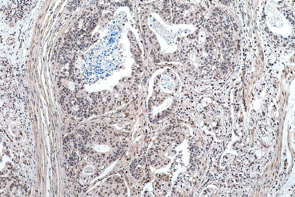 Immunohistochemical analysis of paraffin-embedded human stomach cancer tissue slide using KHC0679 (UBA1 IHC Kit).