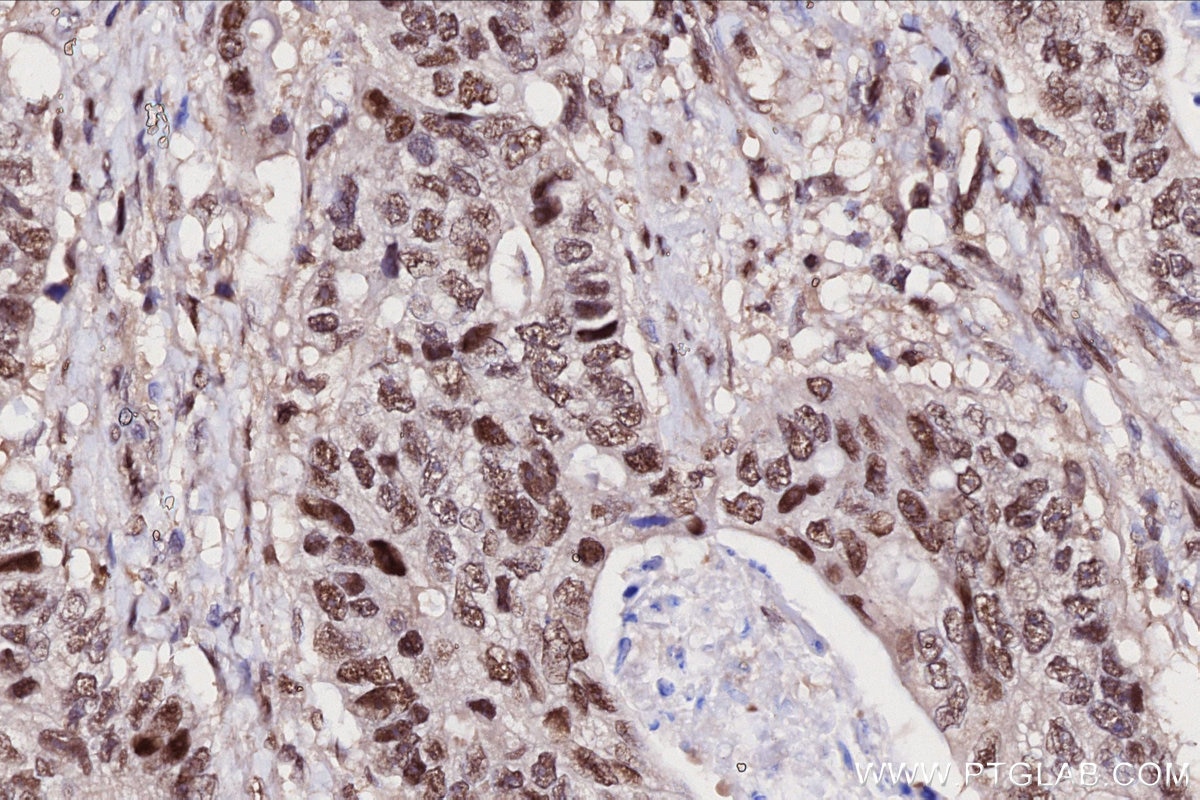 Immunohistochemical analysis of paraffin-embedded human stomach cancer tissue slide using KHC2708 (UBA3 IHC Kit).