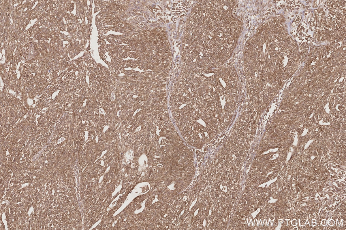 Immunohistochemical analysis of paraffin-embedded human ovary cancer tissue slide using KHC2862 (UBAC1 IHC Kit).