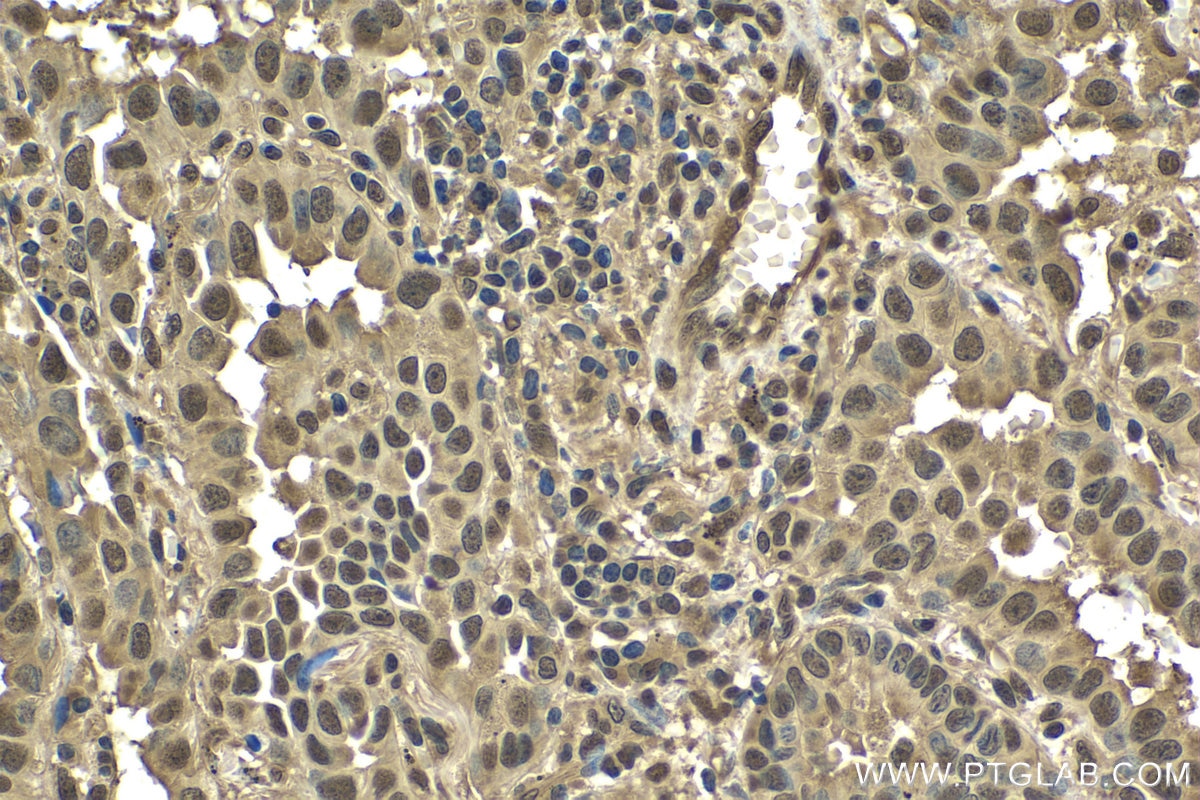 Immunohistochemical analysis of paraffin-embedded human lung cancer tissue slide using KHC1518 (UBB IHC Kit).