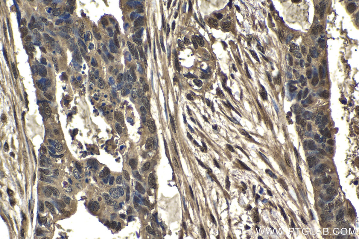 Immunohistochemical analysis of paraffin-embedded human urothelial carcinoma tissue slide using KHC1518 (UBB IHC Kit).