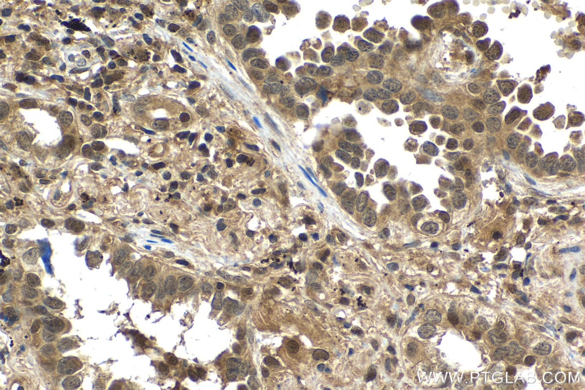 Immunohistochemical analysis of paraffin-embedded human lung cancer tissue slide using KHC1519 (UBC IHC Kit).