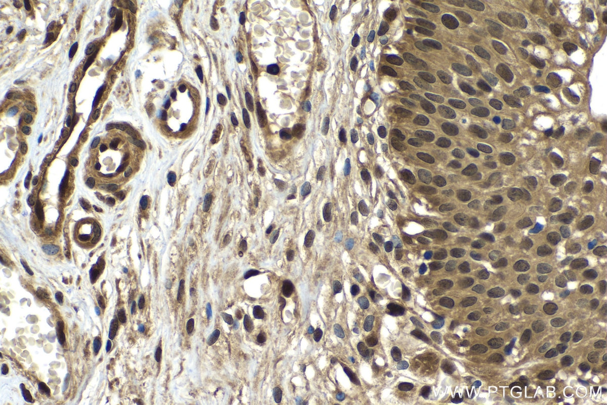 Immunohistochemical analysis of paraffin-embedded human urothelial carcinoma tissue slide using KHC1519 (UBC IHC Kit).