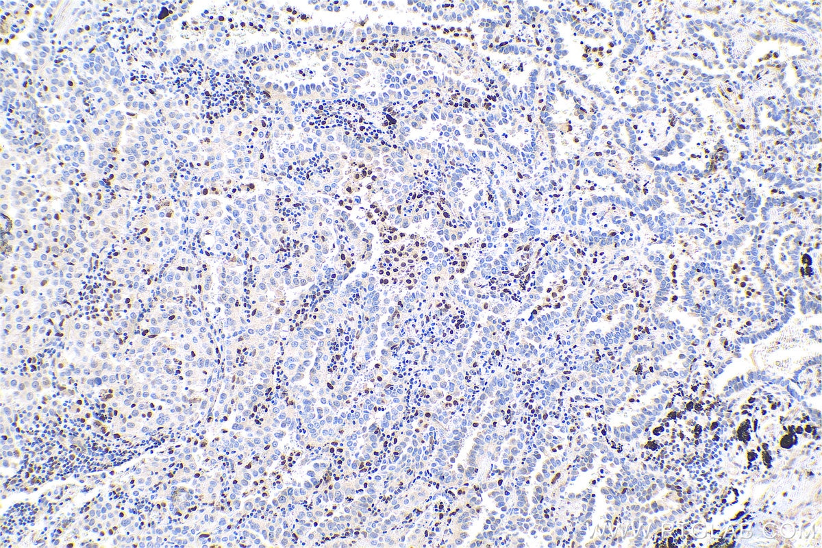 Immunohistochemical analysis of paraffin-embedded human lung cancer tissue slide using KHC0783 (UBD IHC Kit).