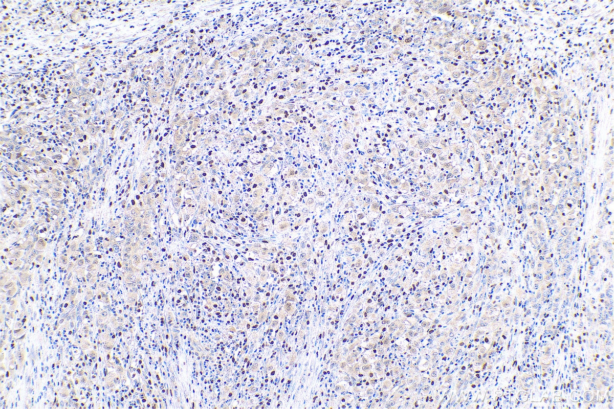 Immunohistochemical analysis of paraffin-embedded human lymphoma tissue slide using KHC0783 (UBD IHC Kit).