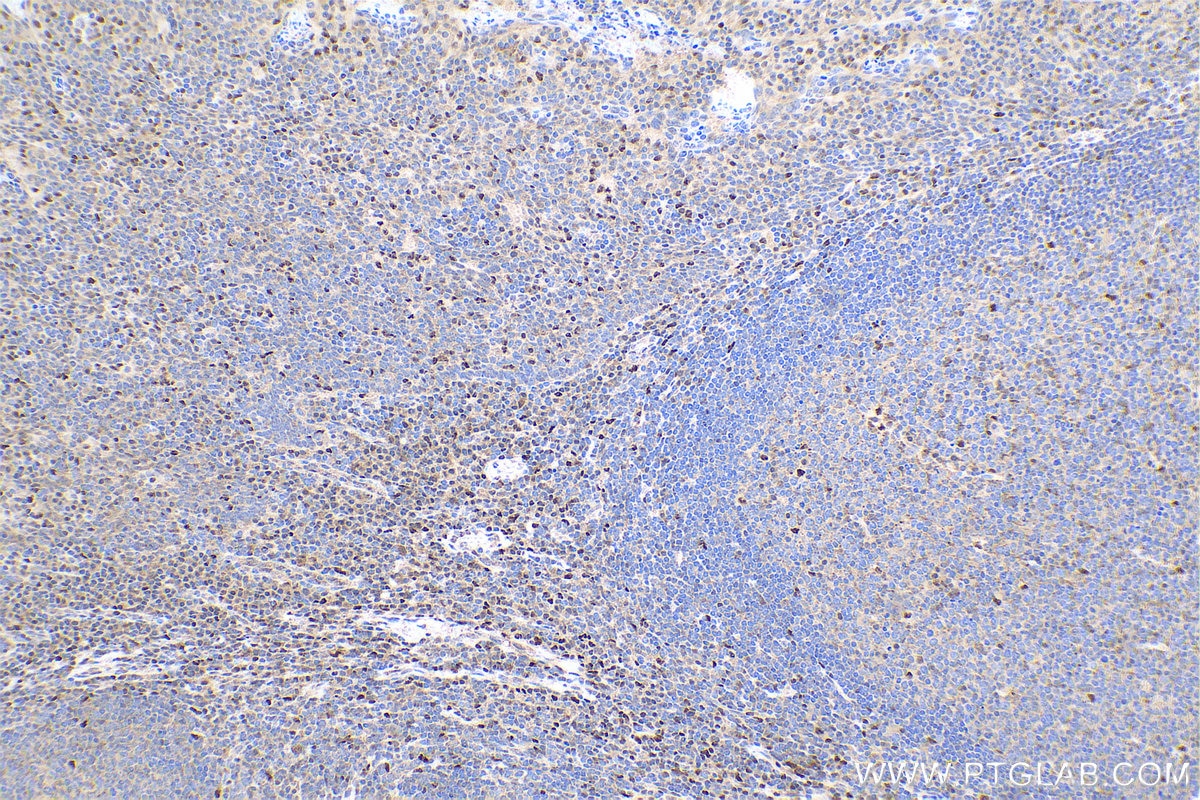 Immunohistochemical analysis of paraffin-embedded human tonsillitis tissue slide using KHC0783 (UBD IHC Kit).