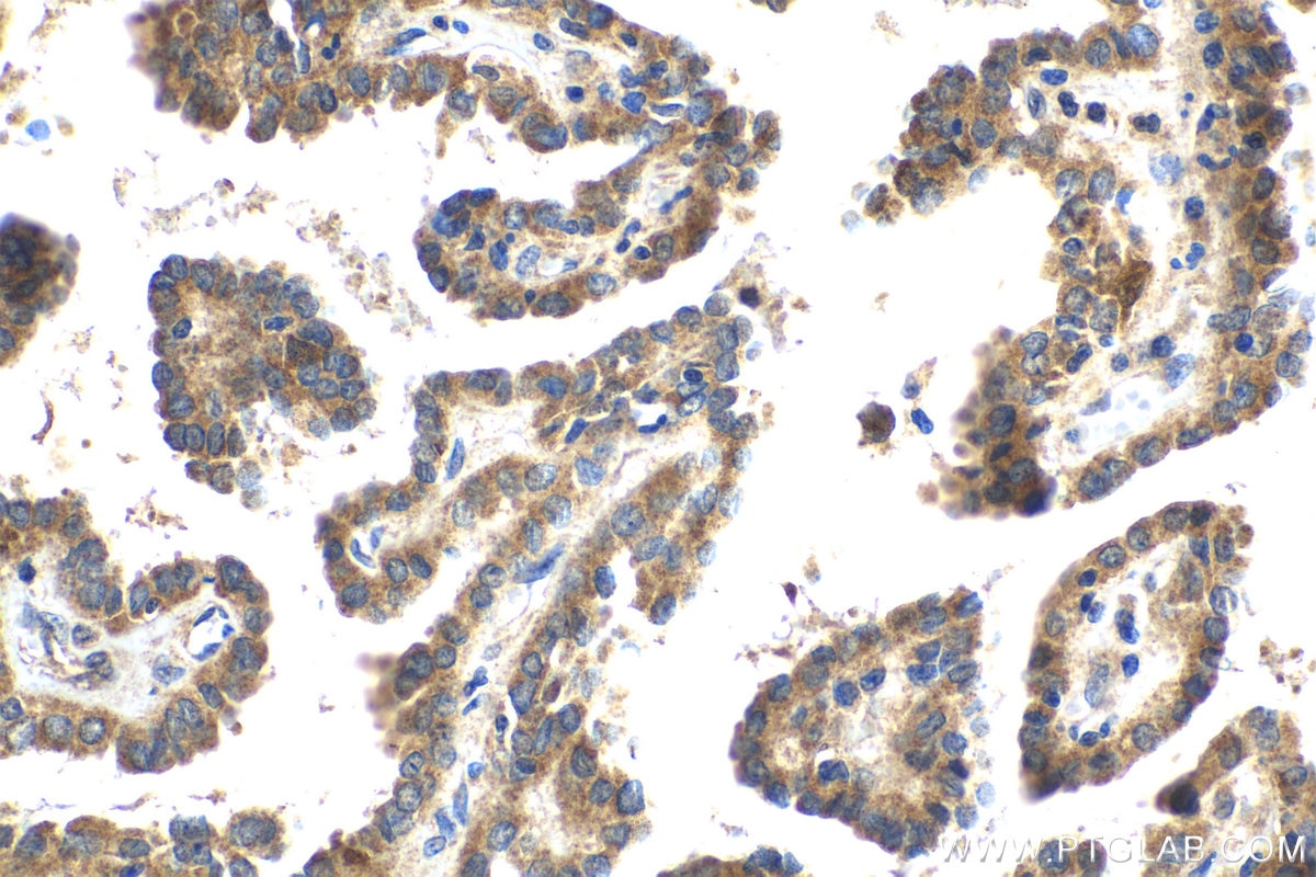 Immunohistochemical analysis of paraffin-embedded human thyroid cancer tissue slide using KHC2052 (UBE2C IHC Kit).