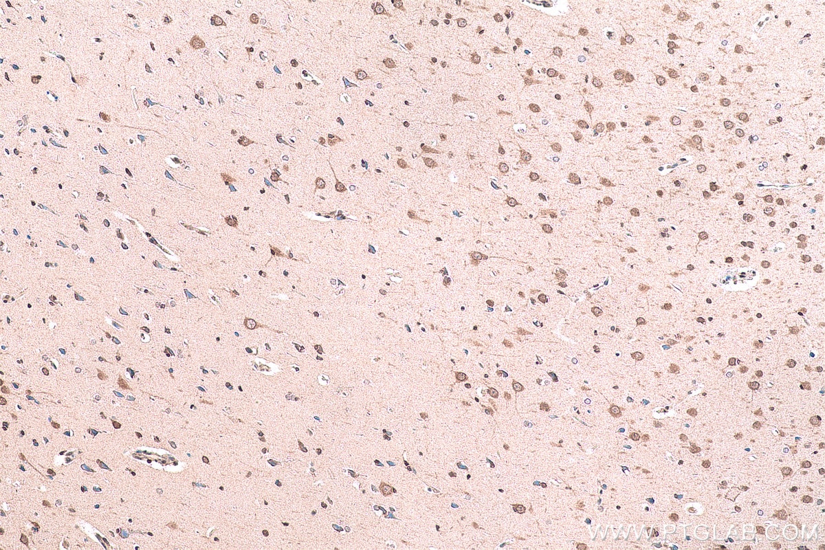 Immunohistochemical analysis of paraffin-embedded human gliomas tissue slide using KHC0905 (UBE2I/UBC9 IHC Kit).