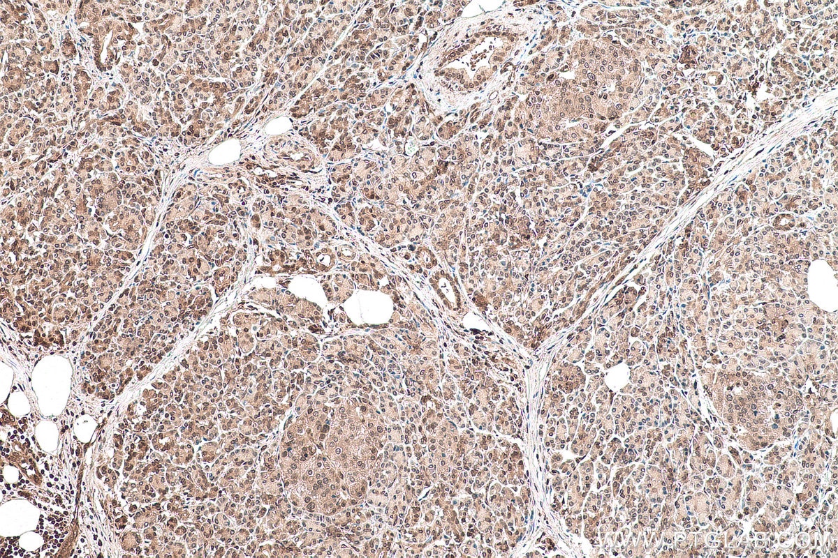 Immunohistochemical analysis of paraffin-embedded human pancreas cancer tissue slide using KHC0905 (UBE2I/UBC9 IHC Kit).