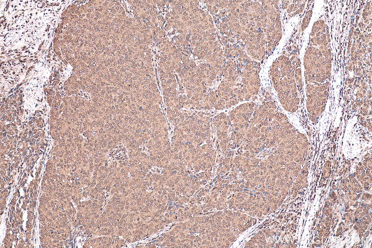 Immunohistochemical analysis of paraffin-embedded human stomach cancer tissue slide using KHC0905 (UBE2I/UBC9 IHC Kit).