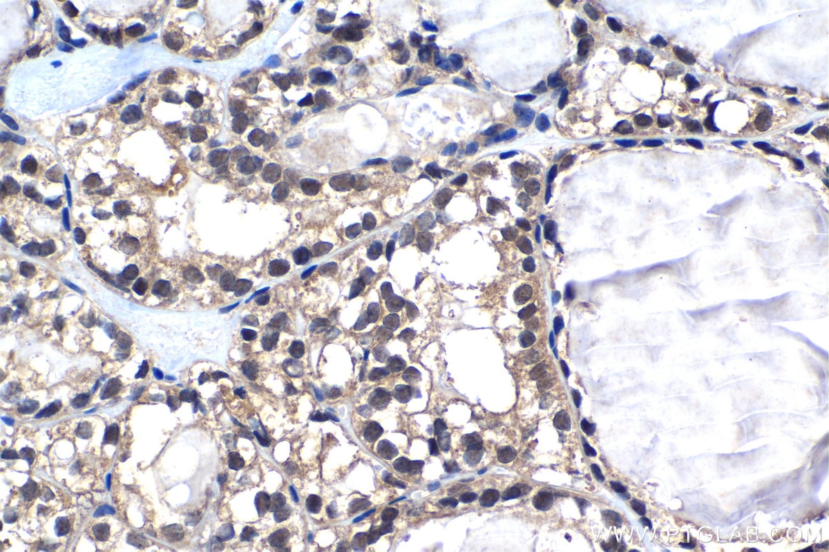 Immunohistochemical analysis of paraffin-embedded human thyroid cancer tissue slide using KHC1296 (UBE2L3 IHC Kit).