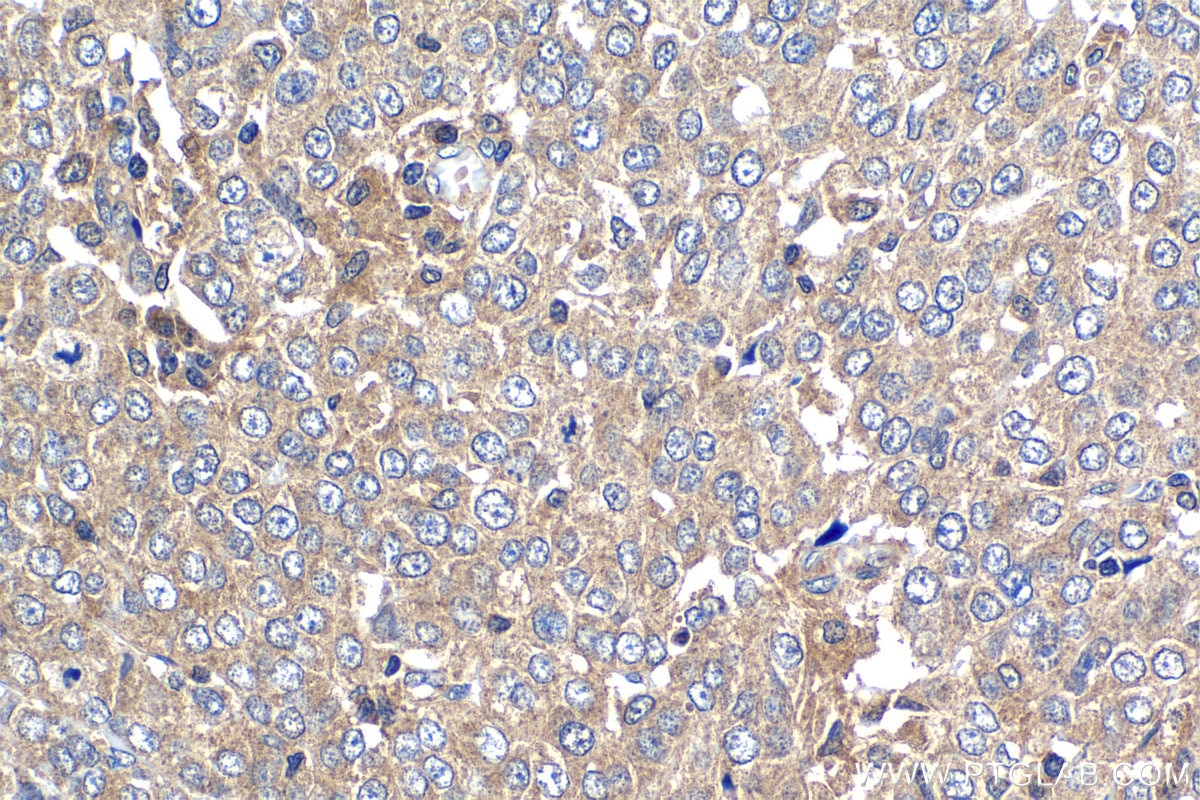 Immunohistochemical analysis of paraffin-embedded human ovary tumor tissue slide using KHC1296 (UBE2L3 IHC Kit).