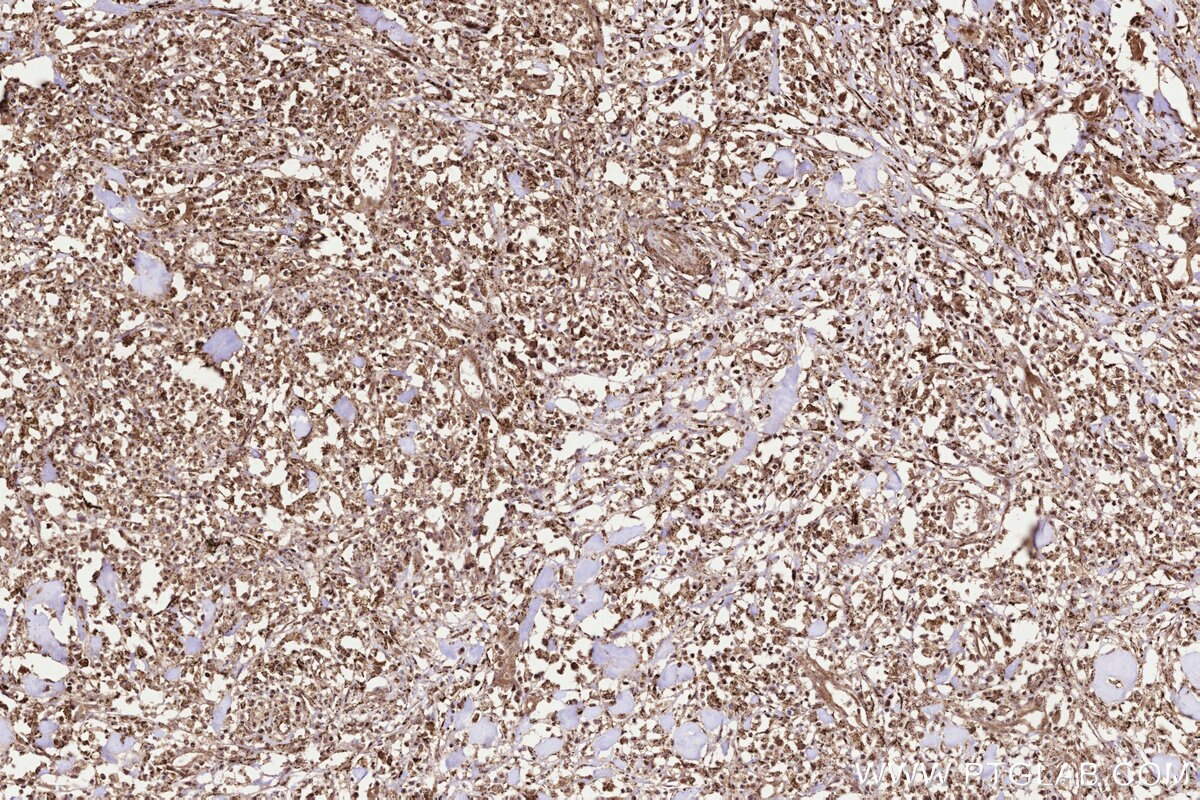 Immunohistochemical analysis of paraffin-embedded human colon cancer tissue slide using KHC3235 (UBE2M/UBC12 IHC Kit). Immunohistochemical analysis of paraffin-embedded human colon cancer tissue slide using KHC3235 (UBE2M/UBC12 IHC Kit).