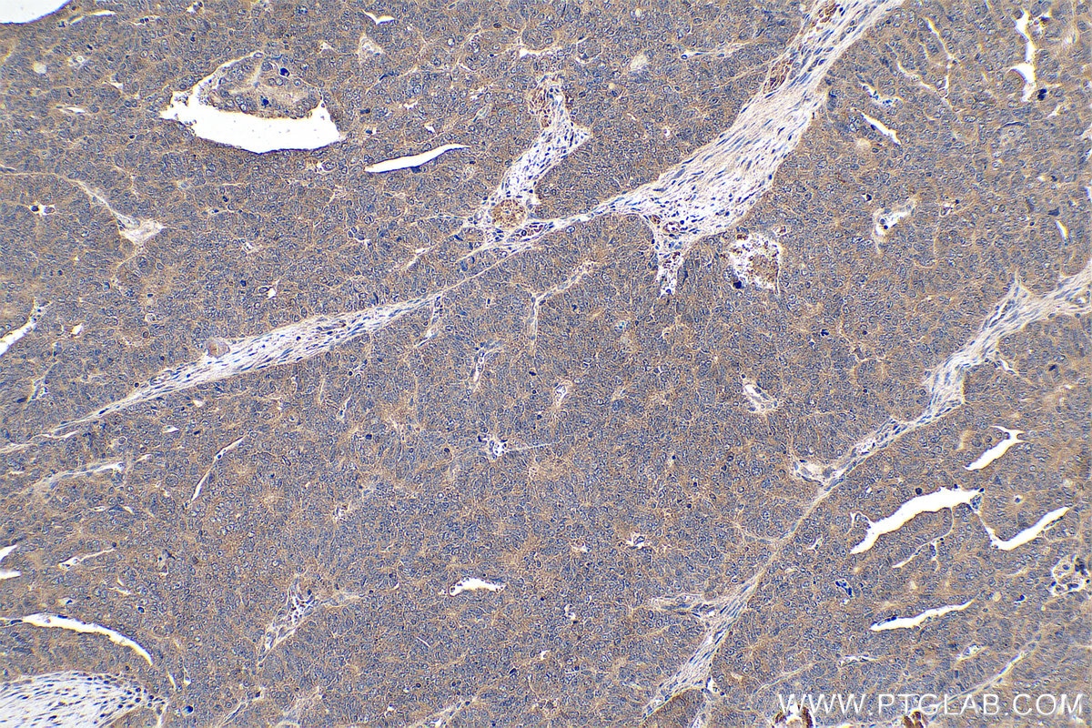 Immunohistochemical analysis of paraffin-embedded human ovary tumor tissue slide using KHC0872 (UBE2N IHC Kit).