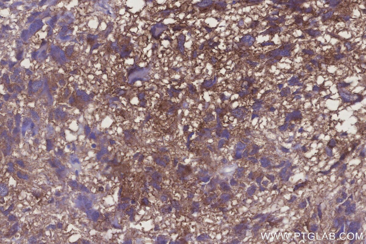 Immunohistochemical analysis of paraffin-embedded human Glioblastoma tissue slide using KHC3276 (UBE2R2 IHC Kit).