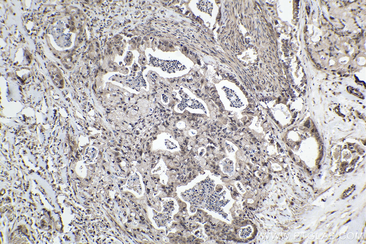 Immunohistochemical analysis of paraffin-embedded human pancreas cancer tissue slide using KHC1602 (UBE3A IHC Kit).