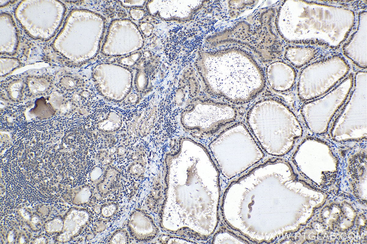 Immunohistochemical analysis of paraffin-embedded human thyroid cancer tissue slide using KHC1602 (UBE3A IHC Kit).