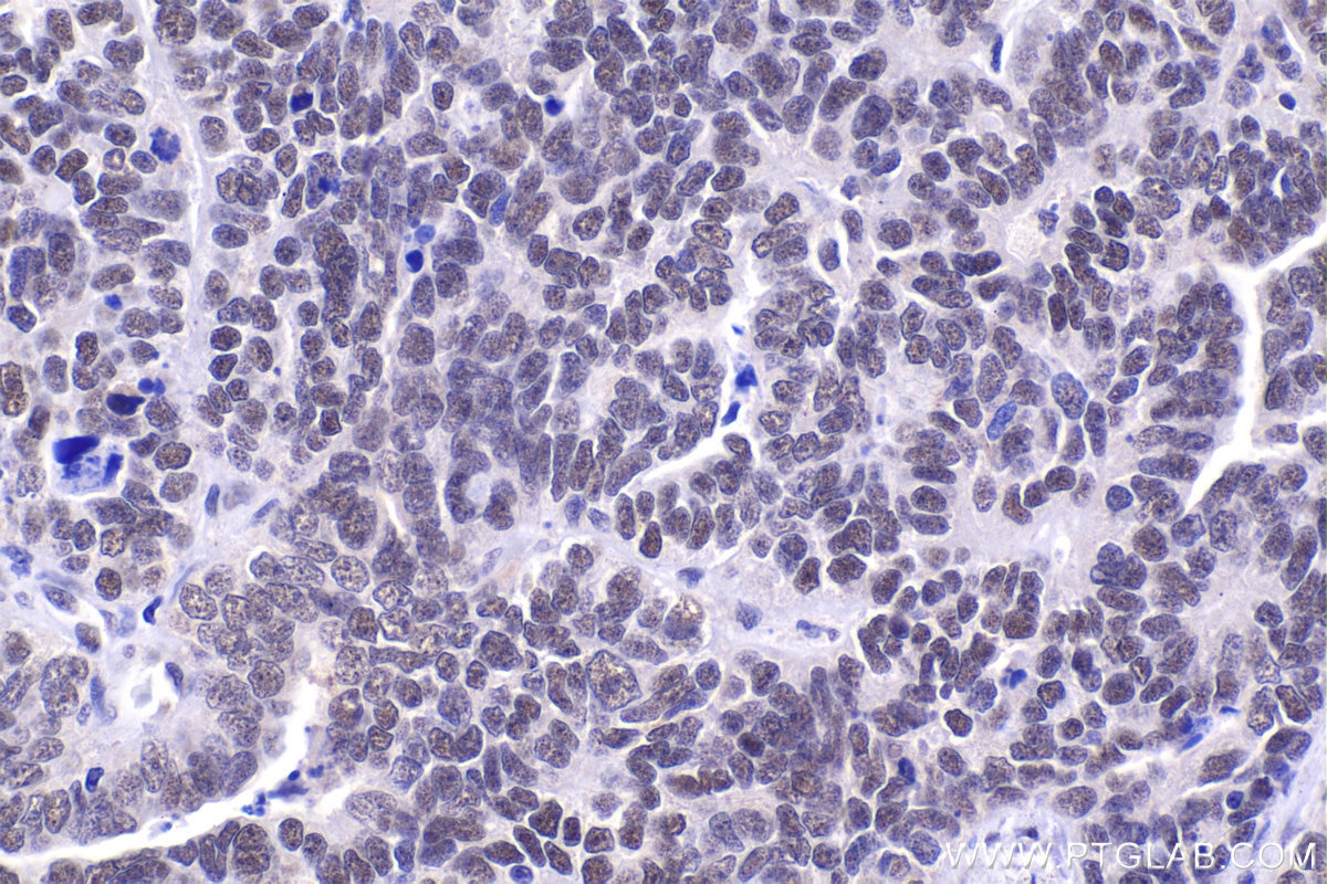 Immunohistochemical analysis of paraffin-embedded human ovary tumor tissue slide using KHC1490 (UBR5 IHC Kit).