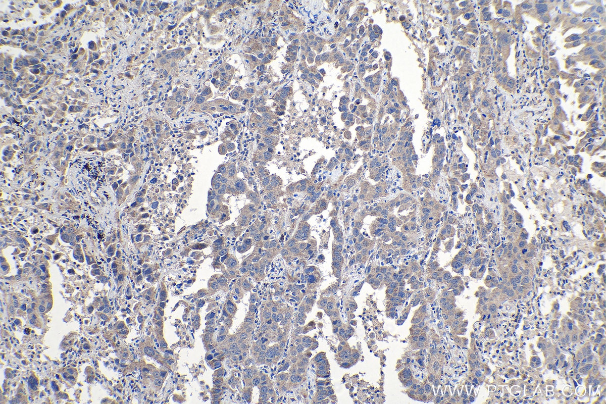 Immunohistochemical analysis of paraffin-embedded human lung cancer tissue slide using KHC1189 (UBTD1 IHC Kit).