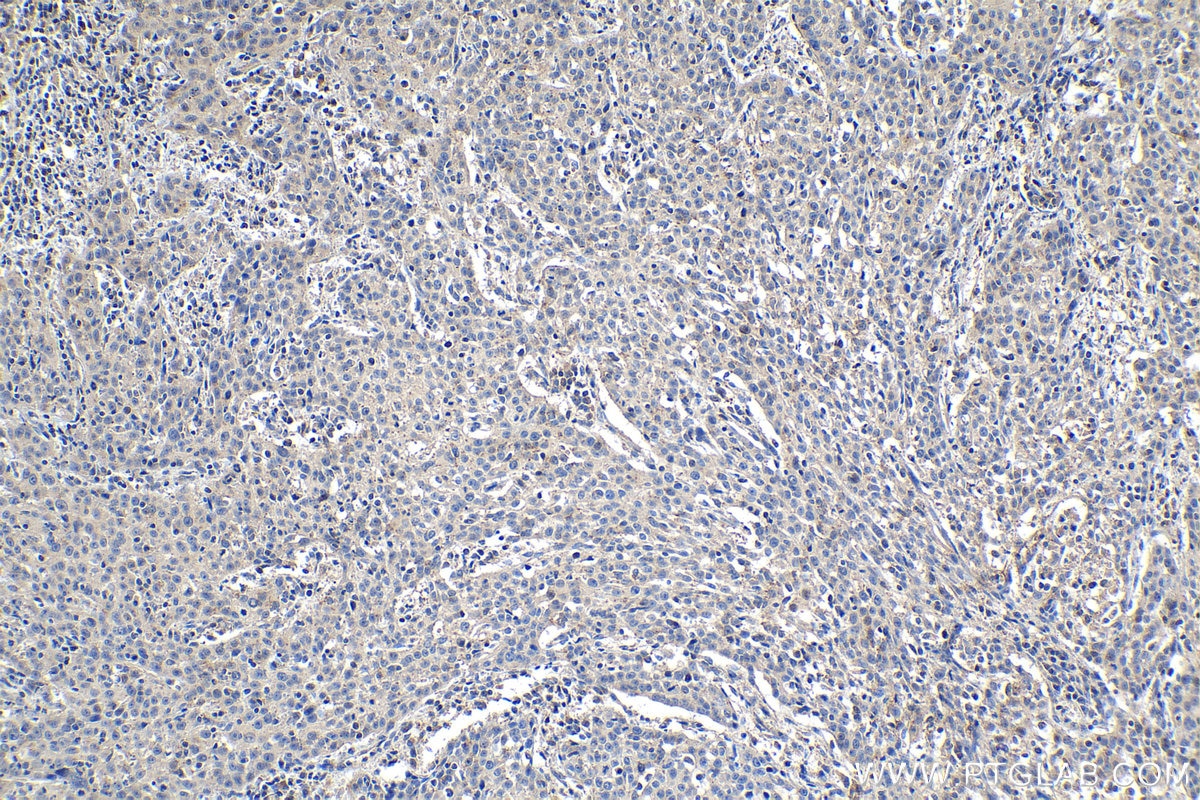 Immunohistochemical analysis of paraffin-embedded human cervical cancer tissue slide using KHC1189 (UBTD1 IHC Kit).
