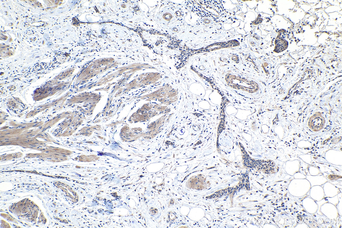 Immunohistochemical analysis of paraffin-embedded human urothelial carcinoma tissue slide using KHC1189 (UBTD1 IHC Kit).