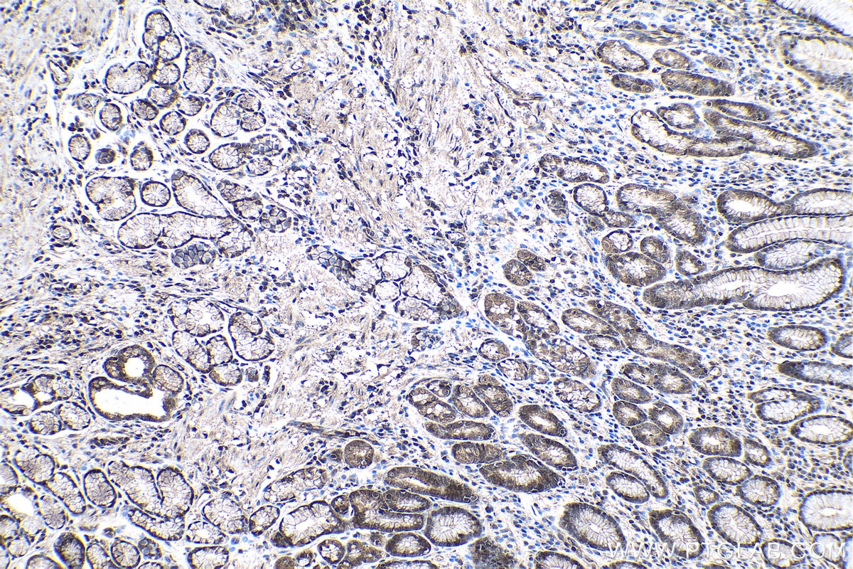Immunohistochemical analysis of paraffin-embedded human stomach cancer tissue slide using KHC1006 (UBXN1 IHC Kit).
