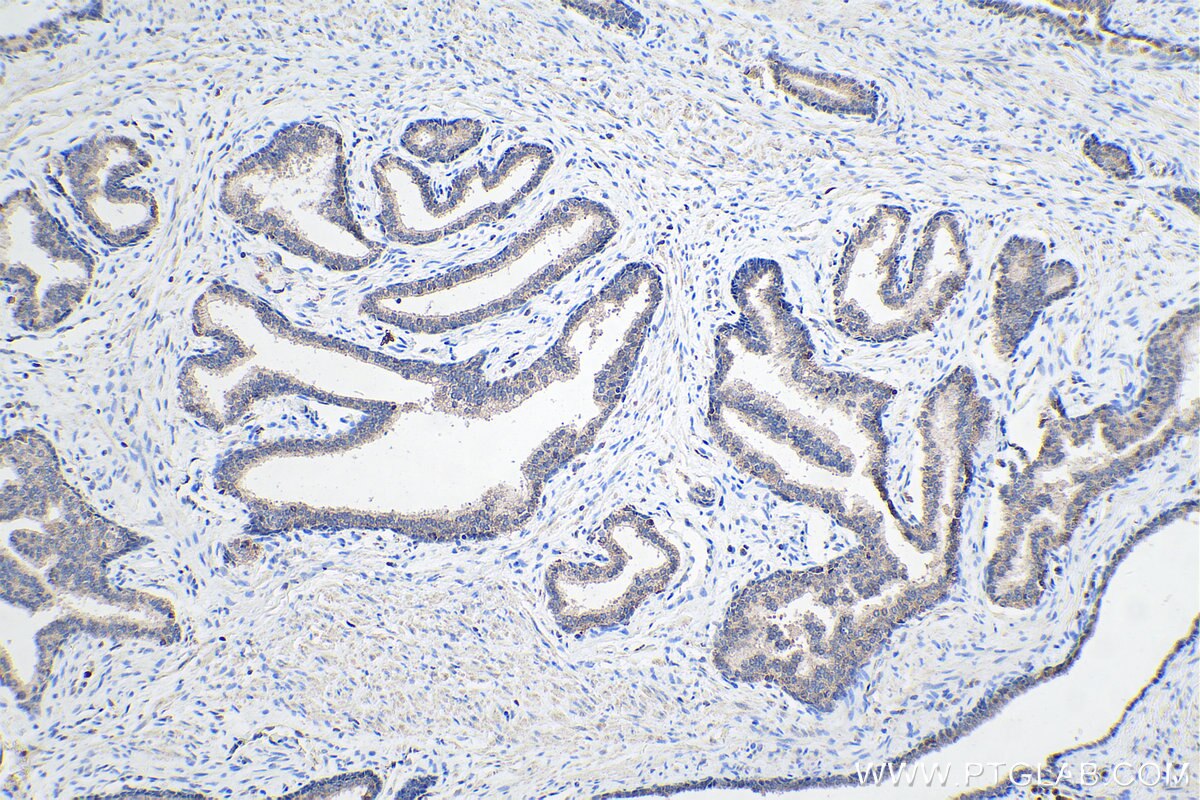 Immunohistochemical analysis of paraffin-embedded human prostate cancer tissue slide using KHC0247 (UCP2 IHC Kit).