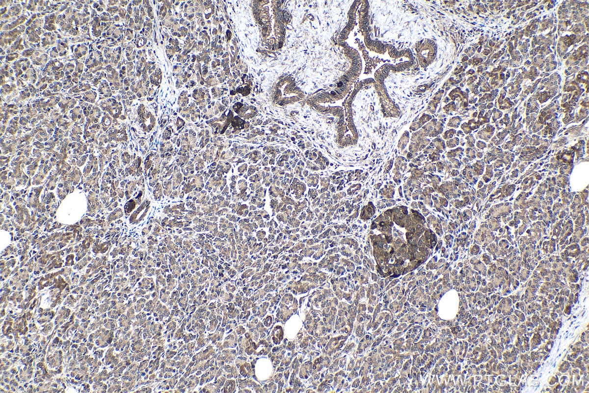 Immunohistochemical analysis of paraffin-embedded human pancreas cancer tissue slide using KHC1037 (UFD1 IHC Kit).