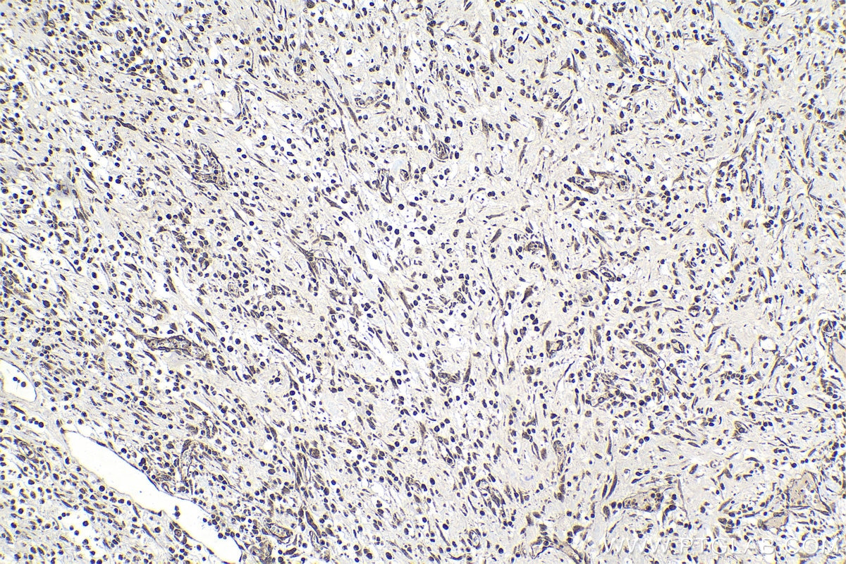 Immunohistochemical analysis of paraffin-embedded human colon cancer tissue slide using KHC1037 (UFD1 IHC Kit).
