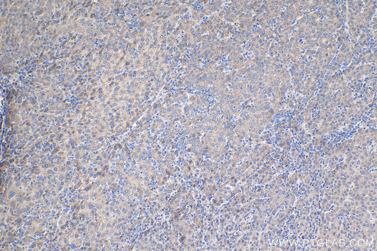 Immunohistochemical analysis of paraffin-embedded human liver cancer tissue slide using KHC1486 (UFL1 IHC Kit).