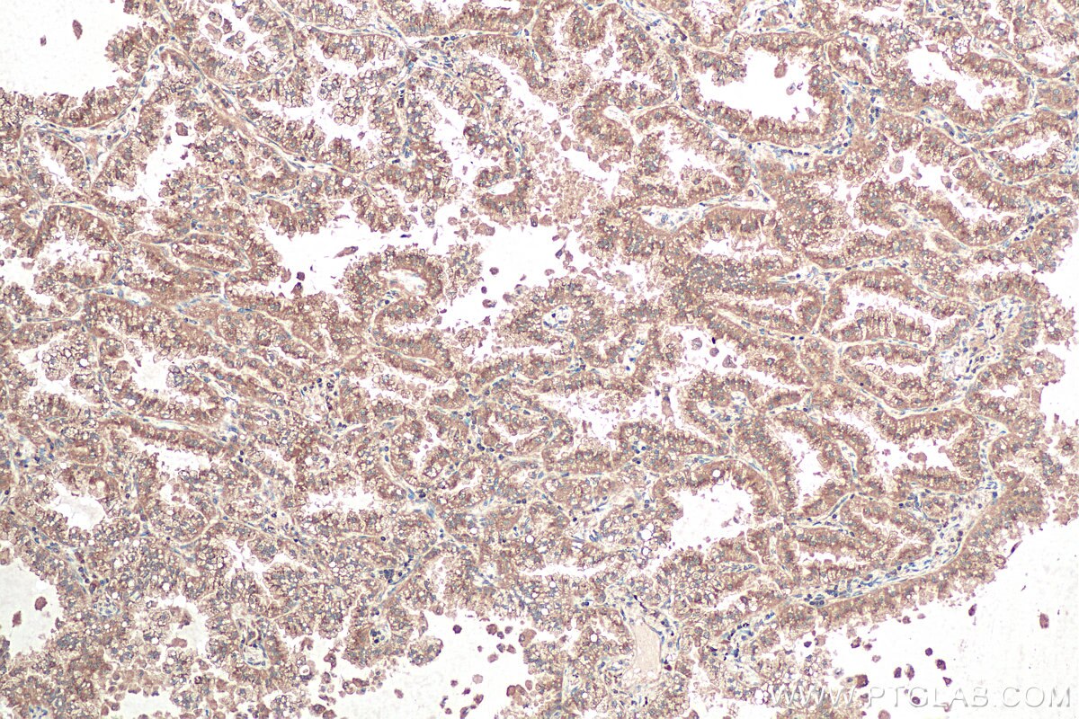 Immunohistochemical analysis of paraffin-embedded human lung cancer tissue slide using KHC0949 (UFM1 IHC Kit).