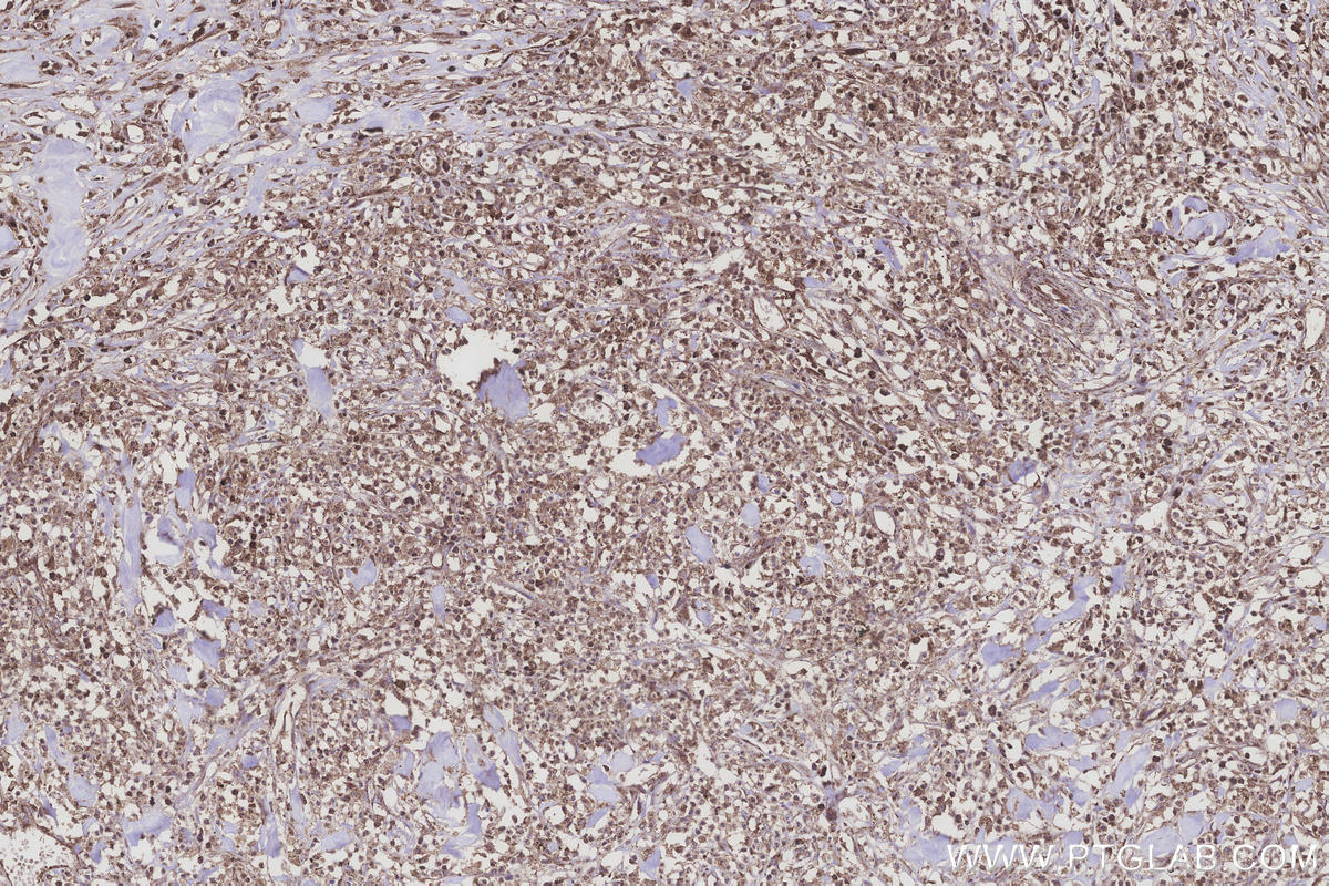 Immunohistochemical analysis of paraffin-embedded human colon cancer tissue slide using KHC3258 (UGT8 IHC Kit).
