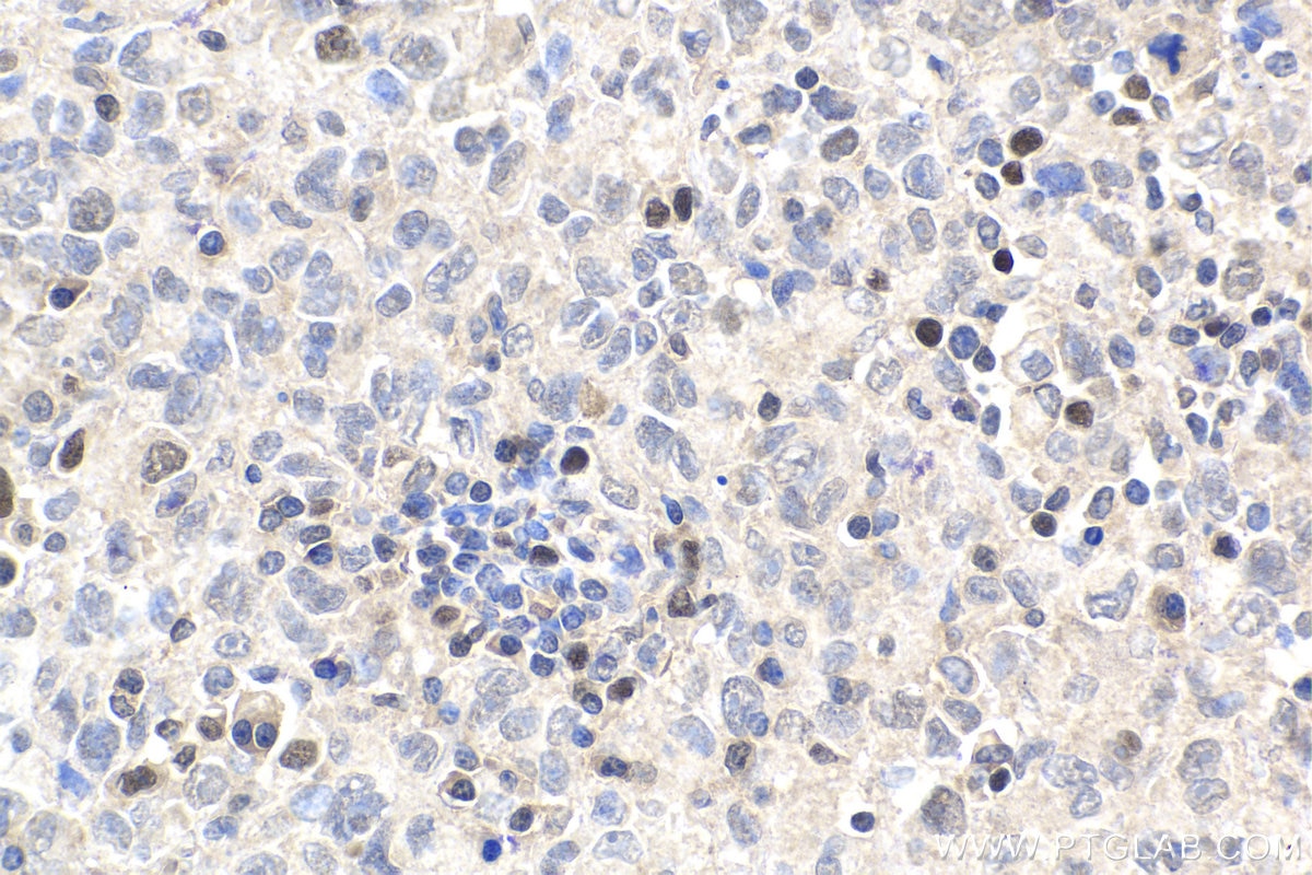 Immunohistochemical analysis of paraffin-embedded human malignant melanoma tissue slide using KHC1887 (UHRF1 IHC Kit).