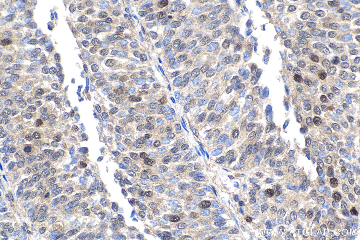 Immunohistochemical analysis of paraffin-embedded human urothelial carcinoma tissue slide using KHC1887 (UHRF1 IHC Kit).