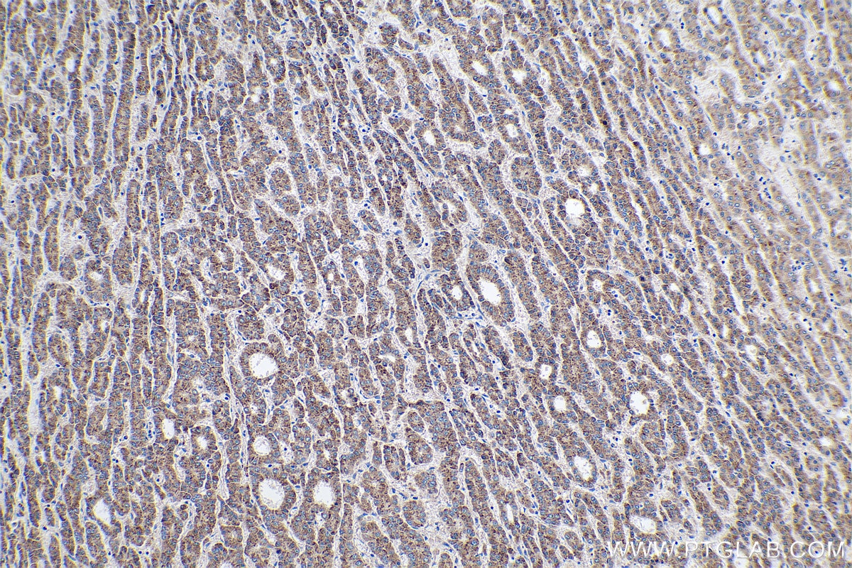 Immunohistochemical analysis of paraffin-embedded human liver cancer tissue slide using KHC0266 (ULBP2 IHC Kit).