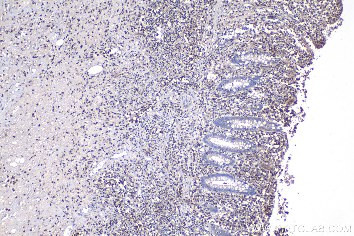 Immunohistochemical analysis of paraffin-embedded human appendicitis tissue slide using KHC1158 (UNC13D IHC Kit).