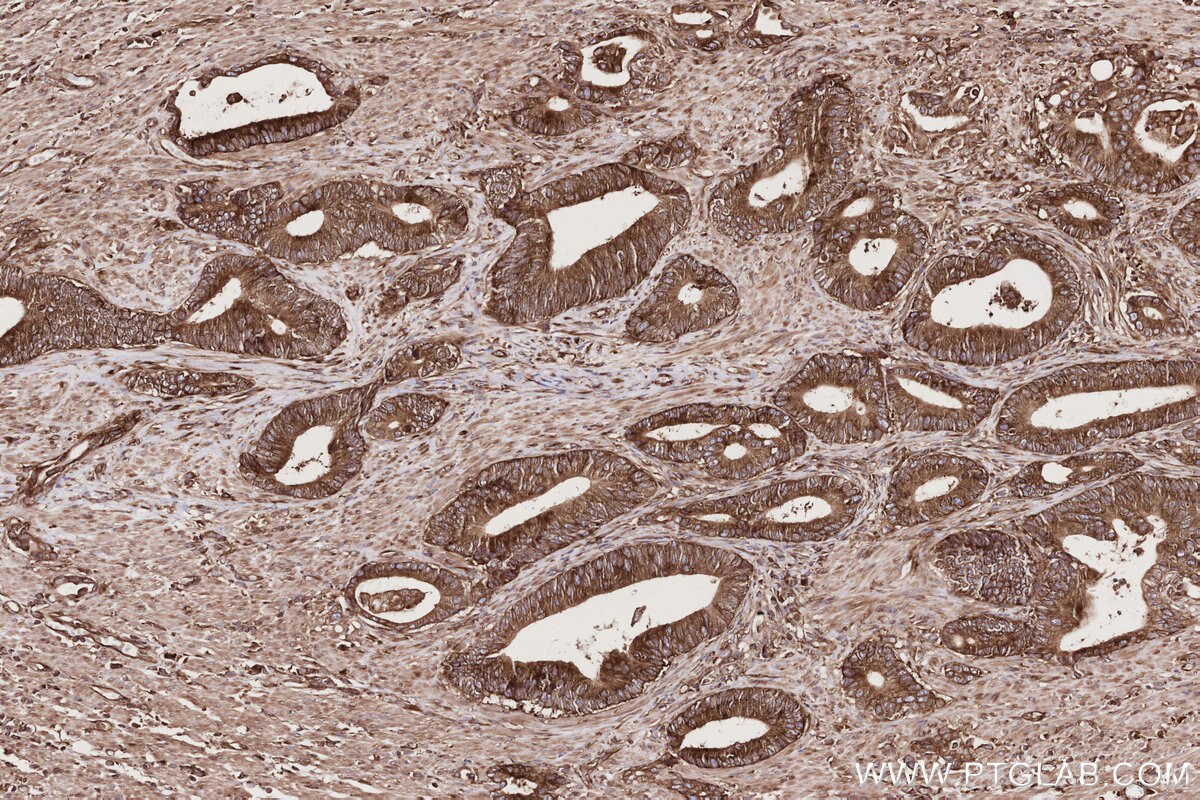 Immunohistochemical analysis of paraffin-embedded human rectal cancer tissue slide using KHC2765 (UPF1 IHC Kit).