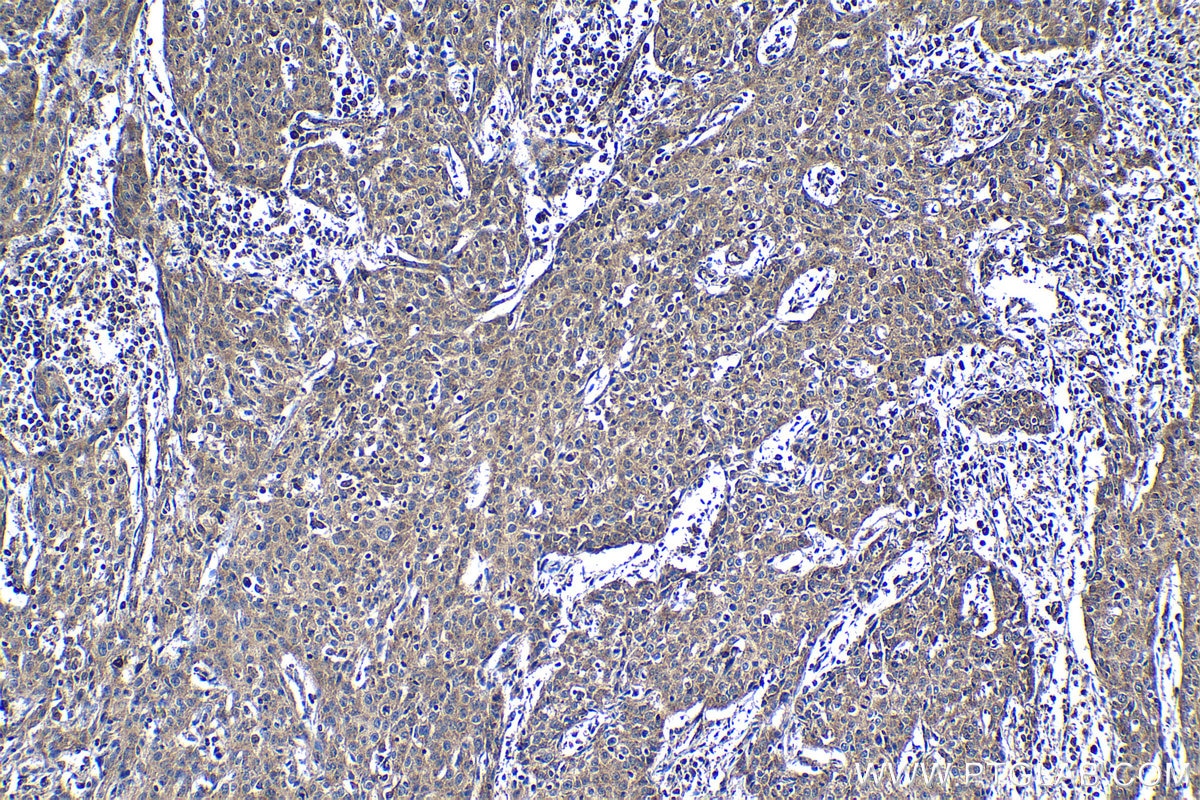 Immunohistochemical analysis of paraffin-embedded human cervical cancer tissue slide using KHC1237 (UPP1 IHC Kit).