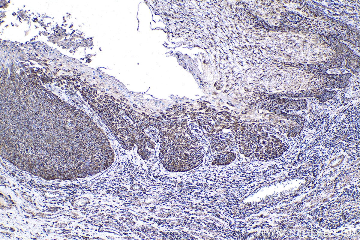 Immunohistochemical analysis of paraffin-embedded human oesophagus cancer tissue slide using KHC1400 (UQCRB IHC Kit).