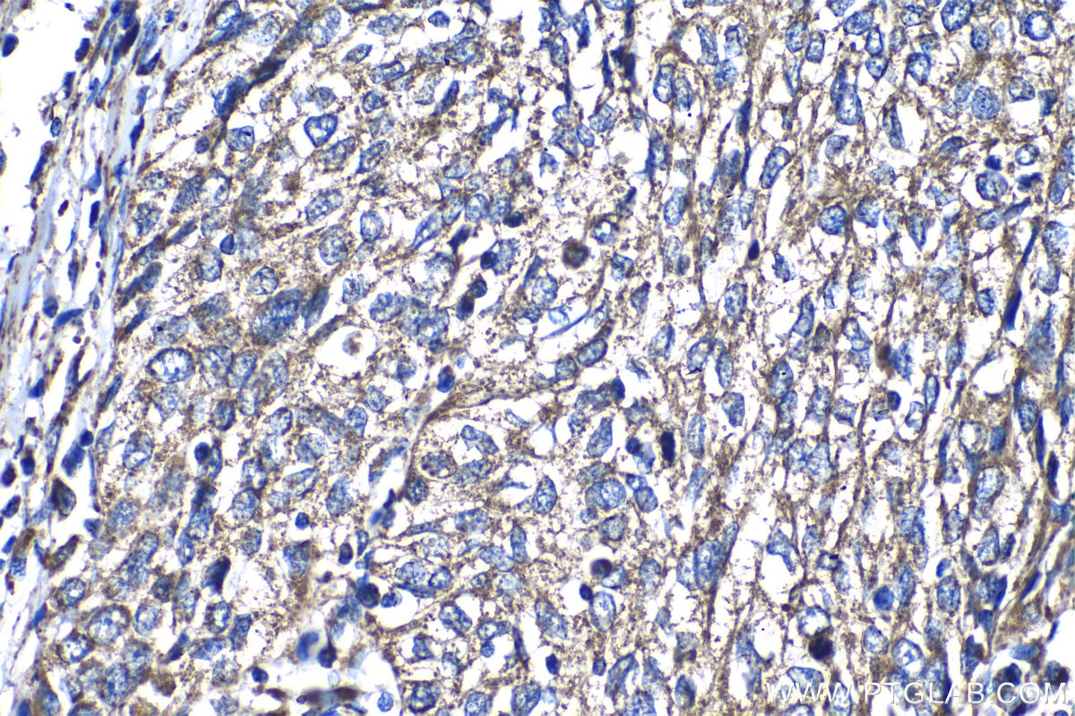 Immunohistochemical analysis of paraffin-embedded human cervical cancer tissue slide using KHC1275 (UQCRFS1 IHC Kit).