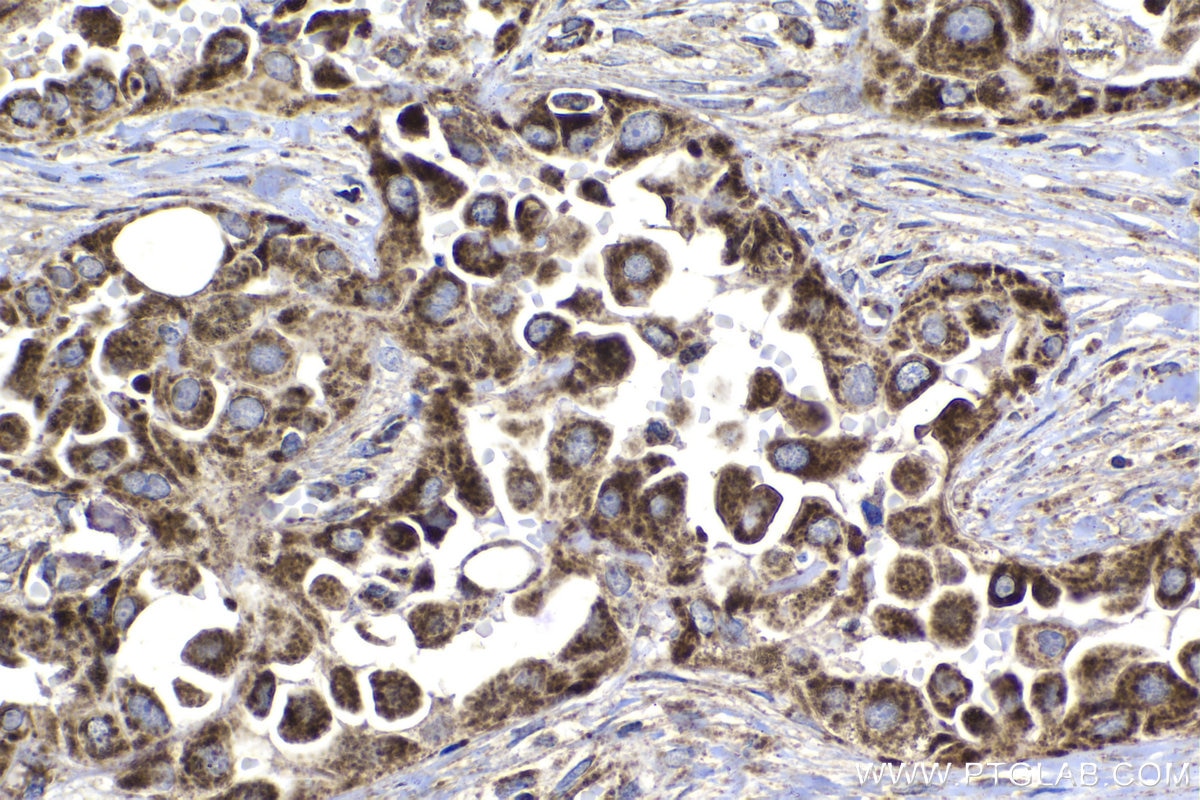 Immunohistochemical analysis of paraffin-embedded human thyroid cancer tissue slide using KHC1374 (UQCRQ IHC Kit).