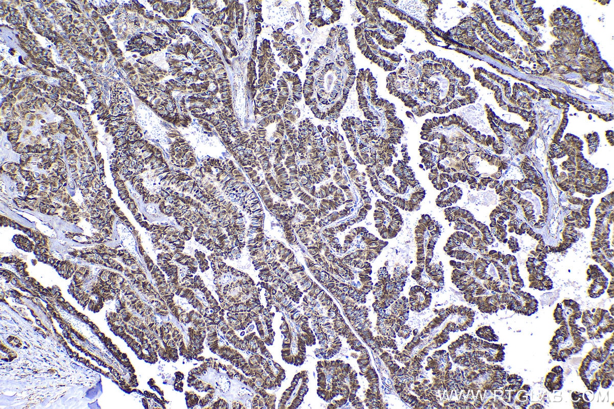 Immunohistochemical analysis of paraffin-embedded human thyroid cancer tissue slide using KHC1374 (UQCRQ IHC Kit).