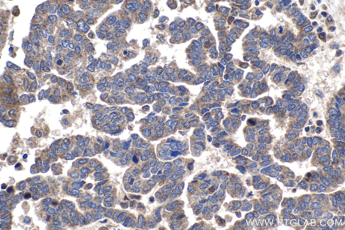 Immunohistochemical analysis of paraffin-embedded human ovary tumor tissue slide using KHC1770 (USH1G IHC Kit).