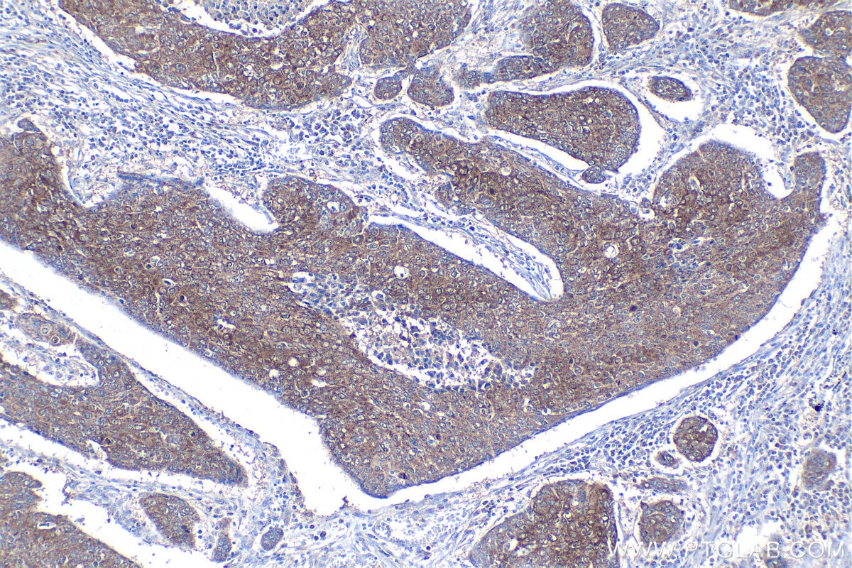 Immunohistochemical analysis of paraffin-embedded human lung cancer tissue slide using KHC1770 (USH1G IHC Kit).