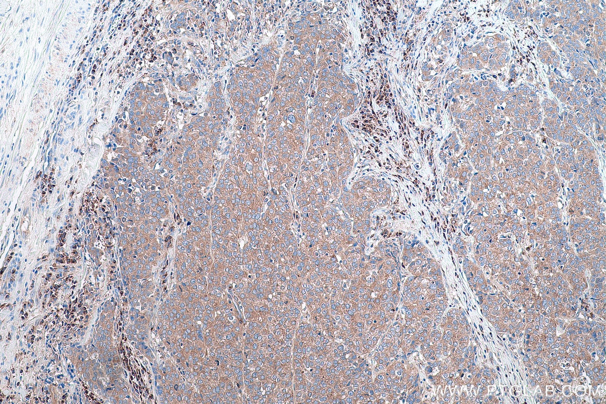 Immunohistochemical analysis of paraffin-embedded human stomach cancer tissue slide using KHC0884 (USO1 IHC Kit).