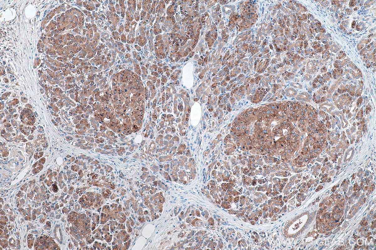 Immunohistochemical analysis of paraffin-embedded human pancreas cancer tissue slide using KHC0884 (USO1 IHC Kit).