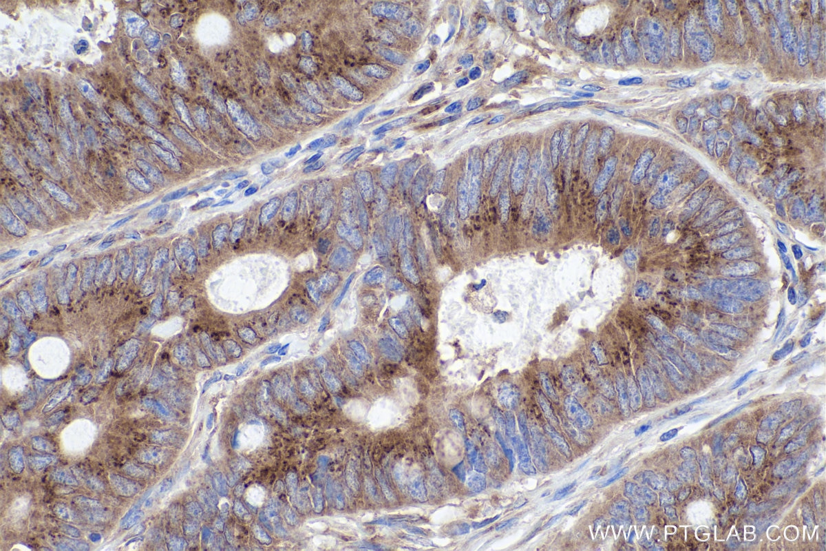 Immunohistochemical analysis of paraffin-embedded human colon cancer tissue slide using KHC0884 (USO1 IHC Kit).