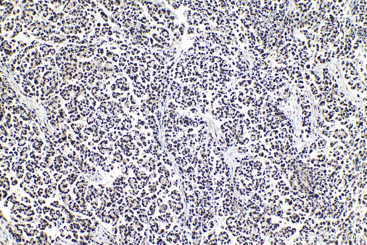 Immunohistochemical analysis of paraffin-embedded human colon cancer tissue slide using KHC1026 (USP11 IHC Kit).